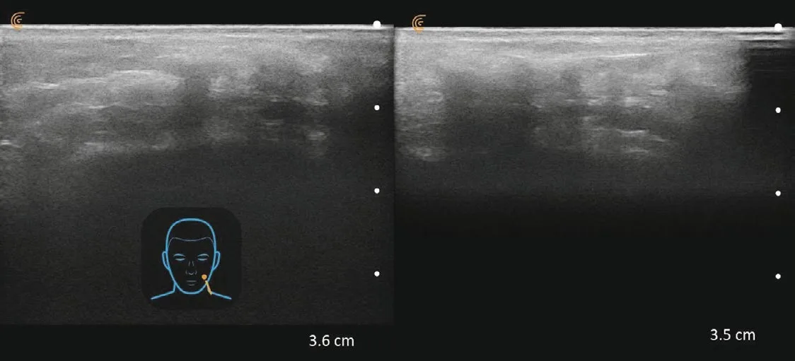Fig 12. Comparative panel of fillers seen with ultrasound